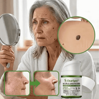ClearSpot™ Creme | Tar bort åldersfläckar och födelsemärken på 36 timmar — Innan din självbild går förlorad
